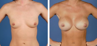 Breast Augmentation, Saline 360cc Moderate Profile before 226912