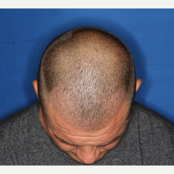 35-44 year old man treated with ARTAS Robotic Hair Transplant by Dr. Ken Williams after 3725169