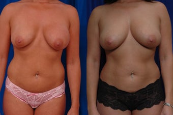 Implant removal and fat grafting before 131959
