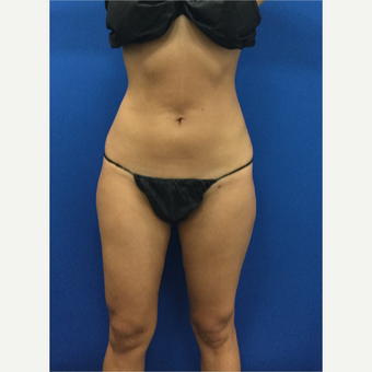 25-34 year old woman treated with Liposculpture after 3142366