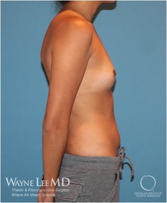 30-35 Year Old Female, Allergan Natrelle Gel, High Profile, 300cc 1427332