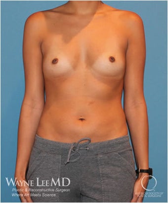30-35 Year Old Female, Allergan Natrelle Gel, High Profile, 300cc before 1427332