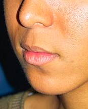 Lip Lift before 635448
