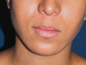 Lip Lift 635448