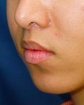 Lip Lift after 635448