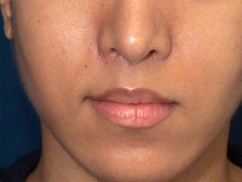 Lip Lift 635448