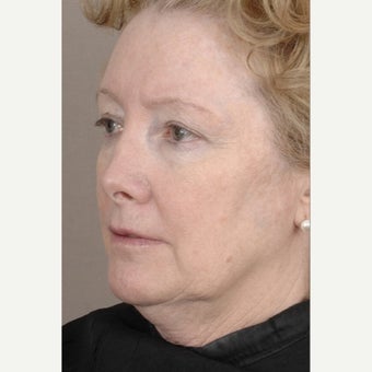 55-64 year old woman treated with Cheek Augmentation before 1907708