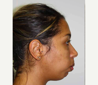 18-24 year old woman treated with Orthognathic Surgery before 2419075