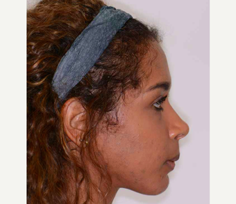 18-24 year old woman treated with Orthognathic Surgery after 2419075