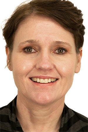 51 year old woman treated with Facelift 3115733