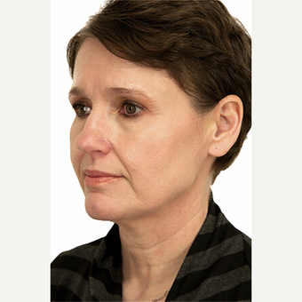 51 year old woman treated with Facelift before 3115733