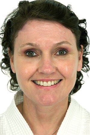 51 year old woman treated with Facelift 3115733
