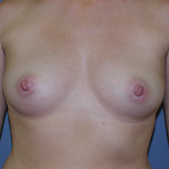 40 year old woman treated with Breast Implants before 3042609