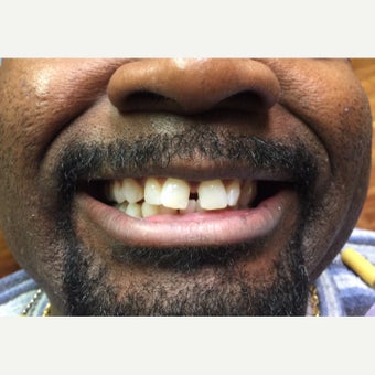 35-44 year old man treated with Porcelain Veneers before 1773766