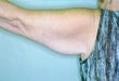 55 year old female patient before 926472