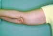 55 year old female patient after 926472