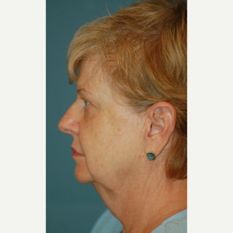 65-74 year old woman treated with Facelift before 2180481