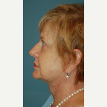65-74 year old woman treated with Facelift after 2180481