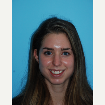 24 year old woman 1 month after rhinoplasty before 3140102