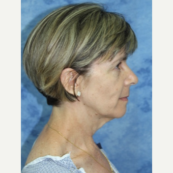 45-54 year old woman treated with Facelift before 3177856