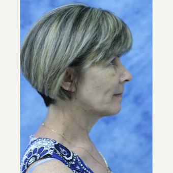 45-54 year old woman treated with Facelift after 3177856