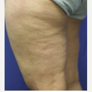 45-54 year old woman treated with Sclerotherapy after 2036974