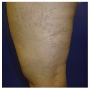 45-54 year old woman treated with Sclerotherapy before 2036974