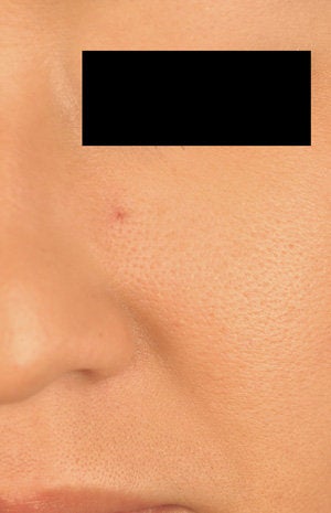 Laser Treatments for Spider Hemangioma before 104184