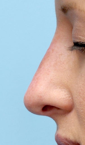 Facial Dermafillers after 1046913