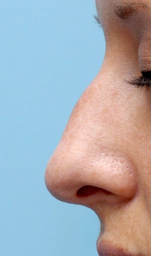 Facial Dermafillers before 1046913