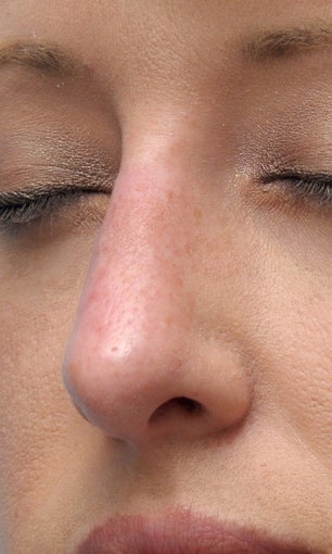 Facial Dermafillers 1046913