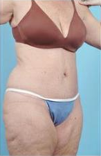 Body Lift 324847