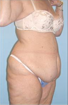 Body Lift 324847