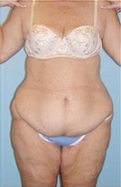 Body Lift before 324847