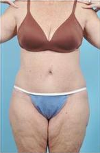 Body Lift after 324847