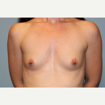 25-34 year old woman treated with Breast Augmentation before 3569905