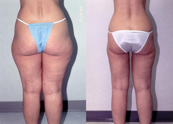 34-year-old woman treated with Liposuction. after 1309211