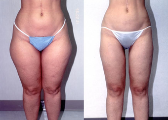 34-year-old woman treated with Liposuction. before 1309211
