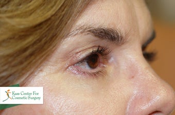 Midface lift, upper and lower eyelid surgery, Hetter resurfacing chemical peel after 433480