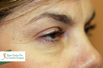 Midface lift, upper and lower eyelid surgery, Hetter resurfacing chemical peel before 433480