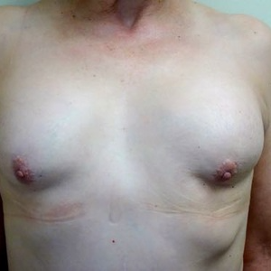 55-64 year old woman treated with Breast Reconstruction before 2802853