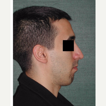 25-34 year old man treated with Rhinoplasty after 3287299