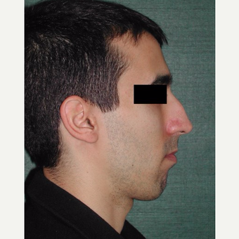25-34 year old man treated with Rhinoplasty before 3287299