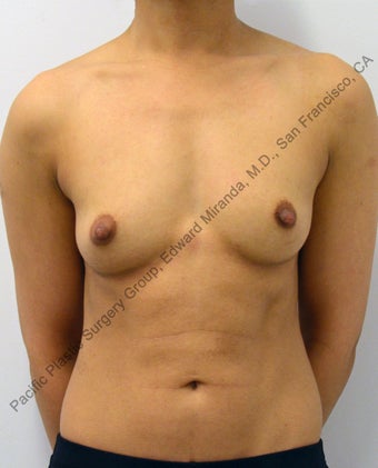 35 y.o. female, Breast Augmentation with Mentor Silicone Implants before 858047