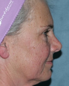 Female Patient Has Fraxel Repair 1064556