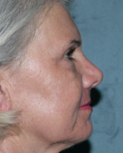 Female Patient Has Fraxel Repair 1064556