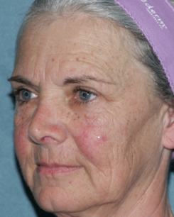 Female Patient Has Fraxel Repair before 1064556