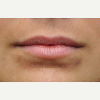 Juvederm to add volume and naturally roll the lips outward before 3097344