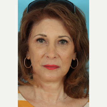 55-64 year old woman treated with Facelift after 3691356