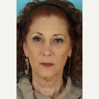 55-64 year old woman treated with Facelift before 3691356